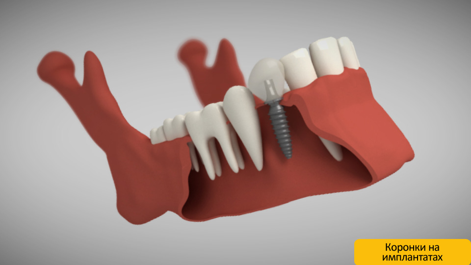 Имплантация – достаточно сложная стоматологическая операция