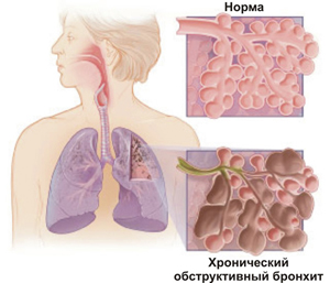 Курение и хроническая обструктивная болезнь легких